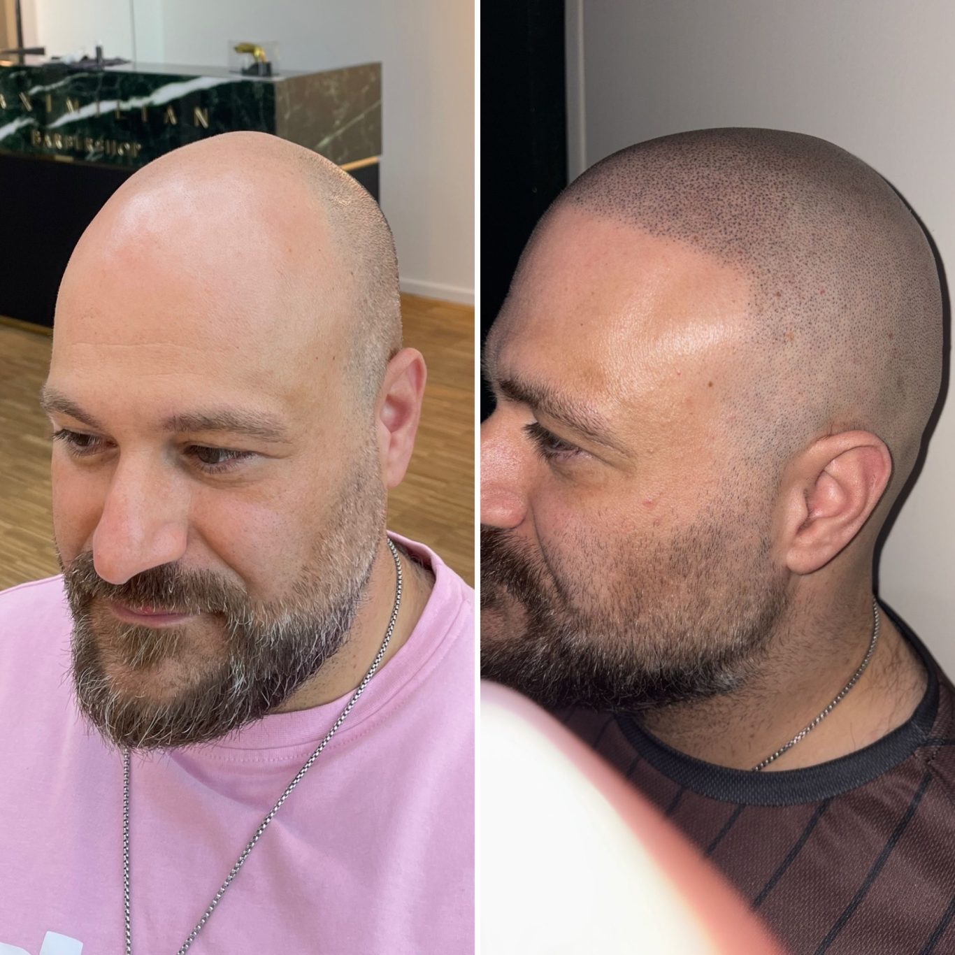 Vor und nach Scalp Micropigmentation Vorher/Nachher Bild