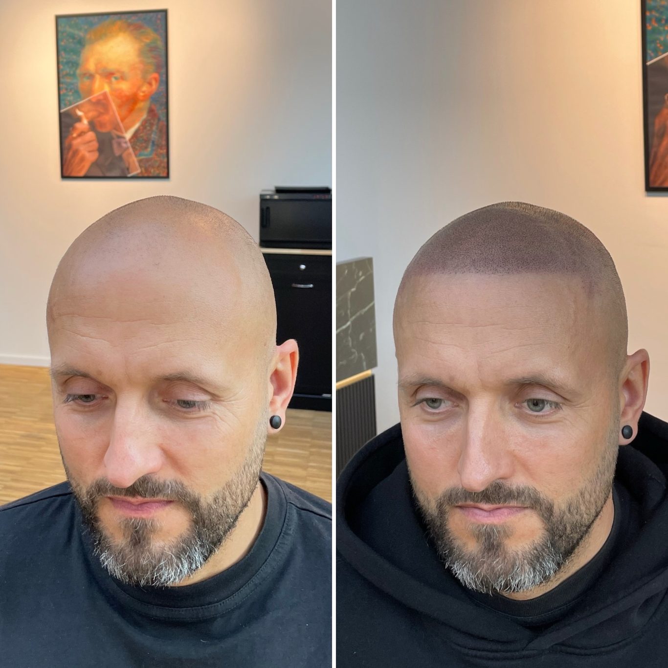 Vor und nach Scalp Micropigmentation Vorher/Nachher Bild